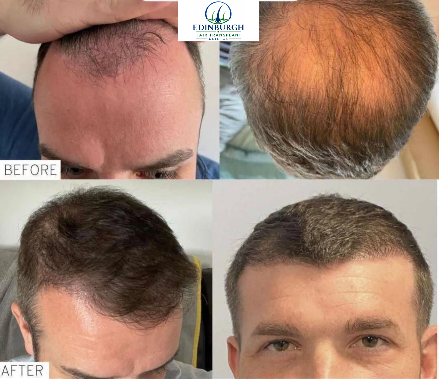 Danny hair transplant before and after comparison