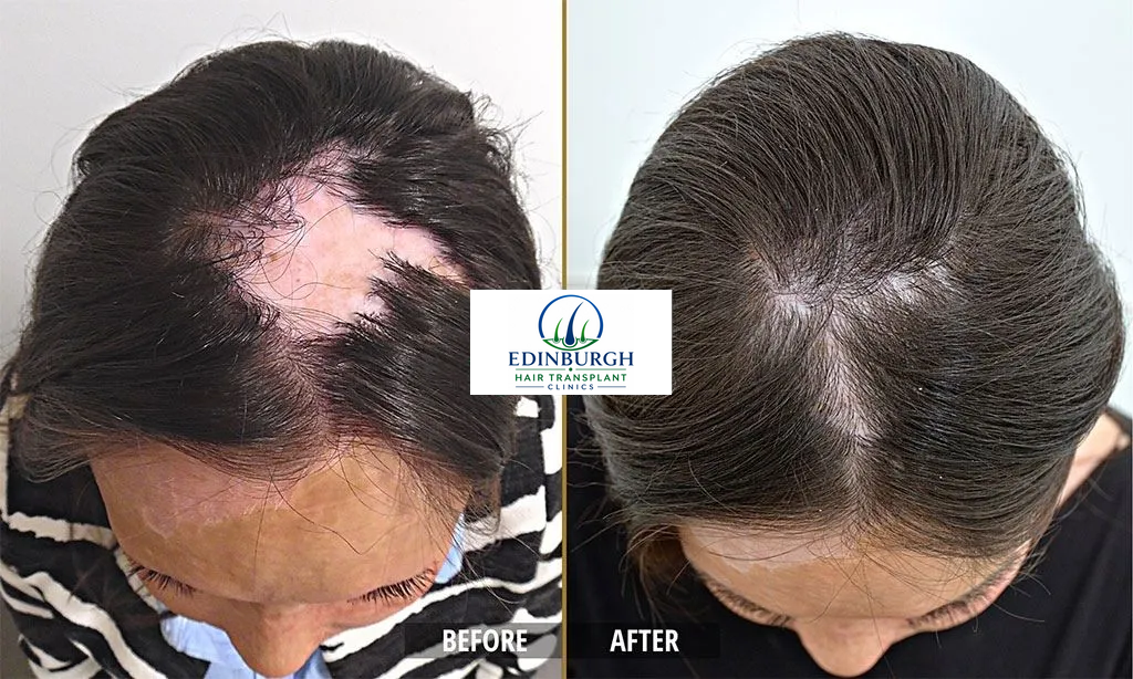 Helen hair transplant before and after comparison