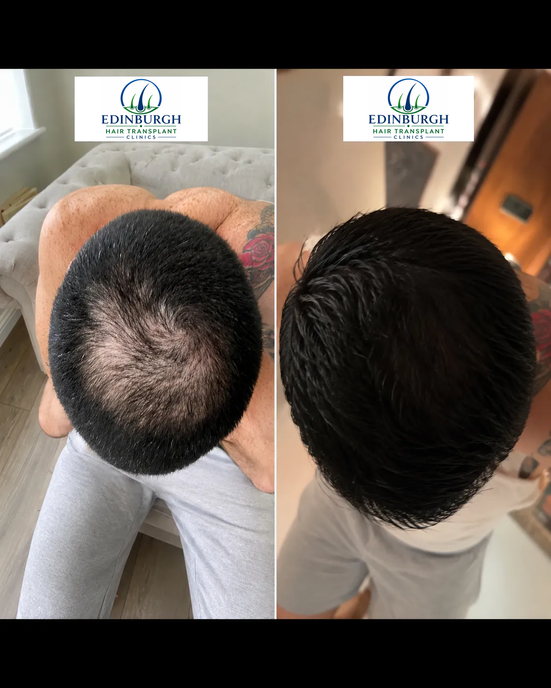Johnathan hair transplant before and after comparison