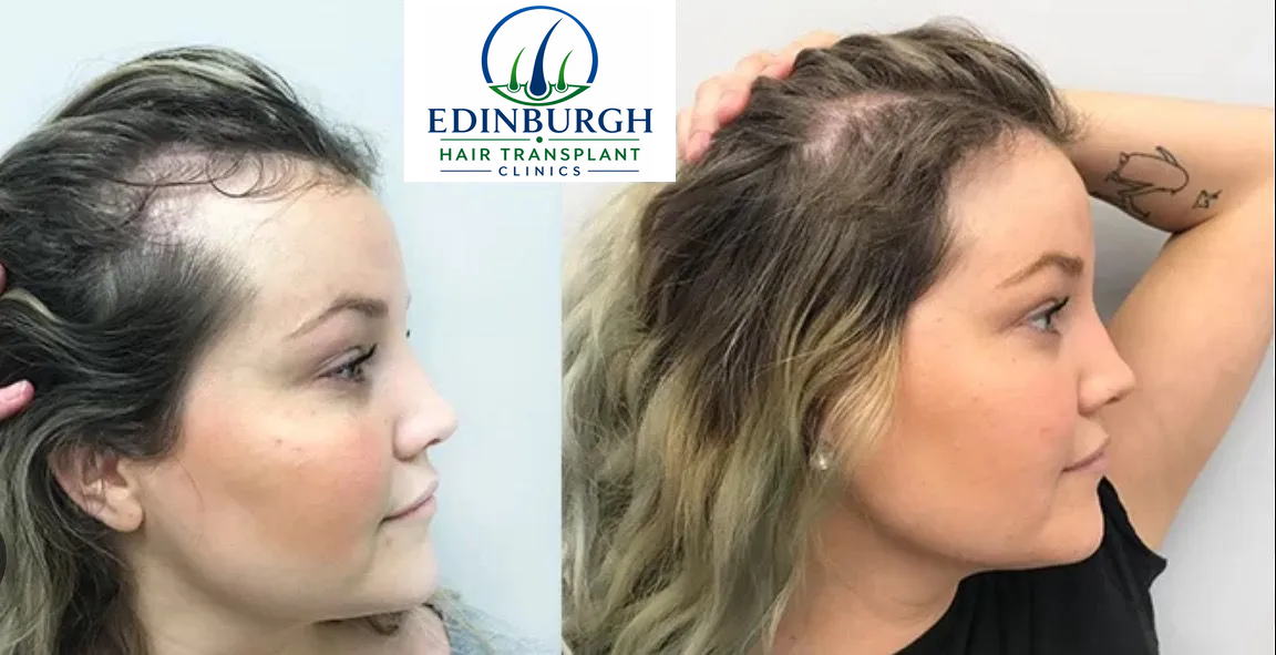 Kelly hair transplant before and after comparison