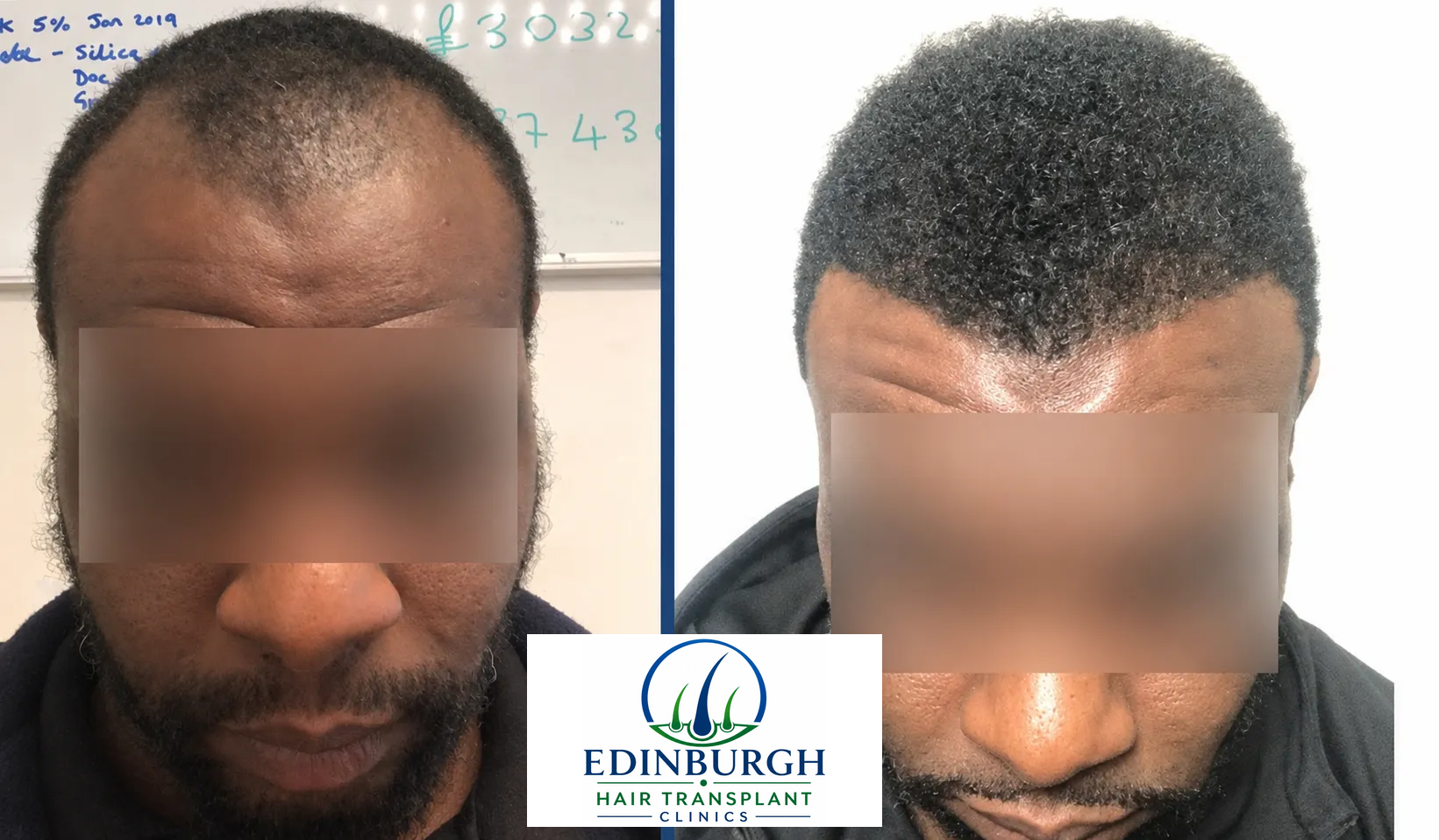 Kelvin hair transplant before and after comparison