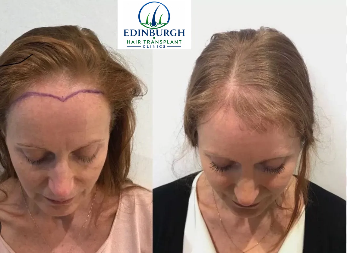 Lyn hair transplant before and after comparison