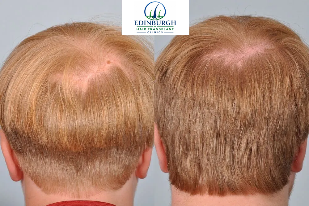 Pete hair transplant before and after comparison