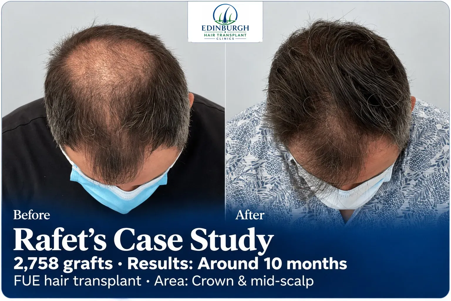 Rafet: FUE, Crown and mid-scalp, 2,758 grafts, results at 10 months