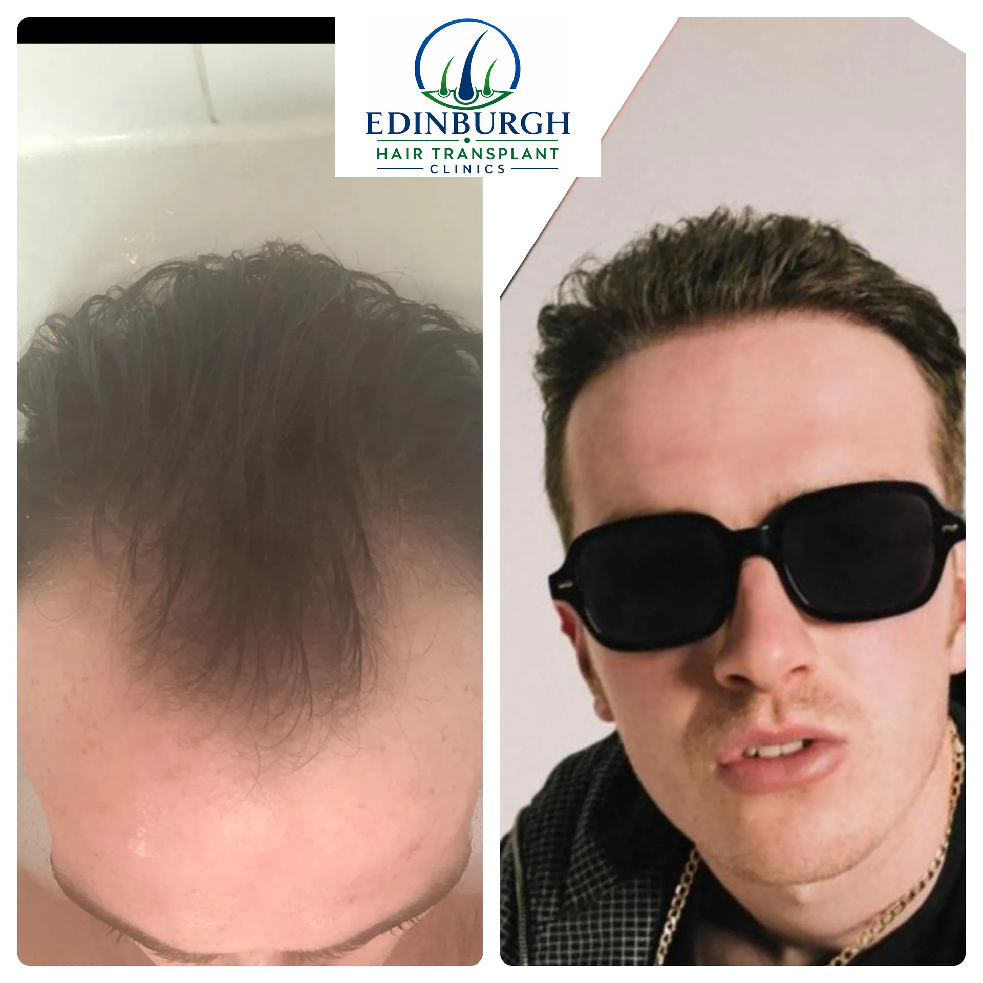 Ryan hair transplant before and after comparison