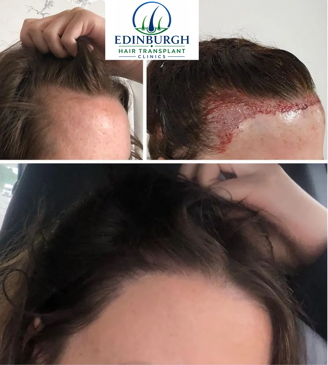 Sally hair transplant before and after comparison