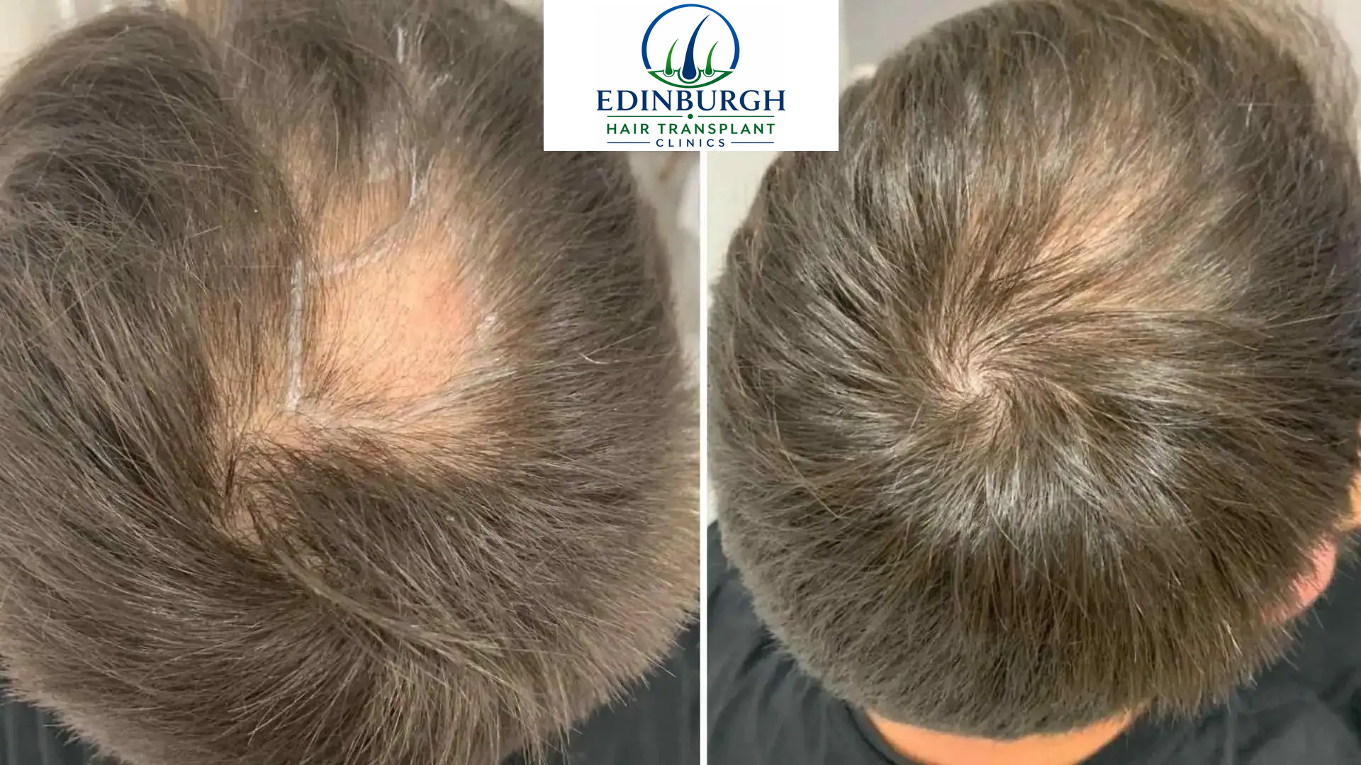 Sam hair transplant before and after comparison