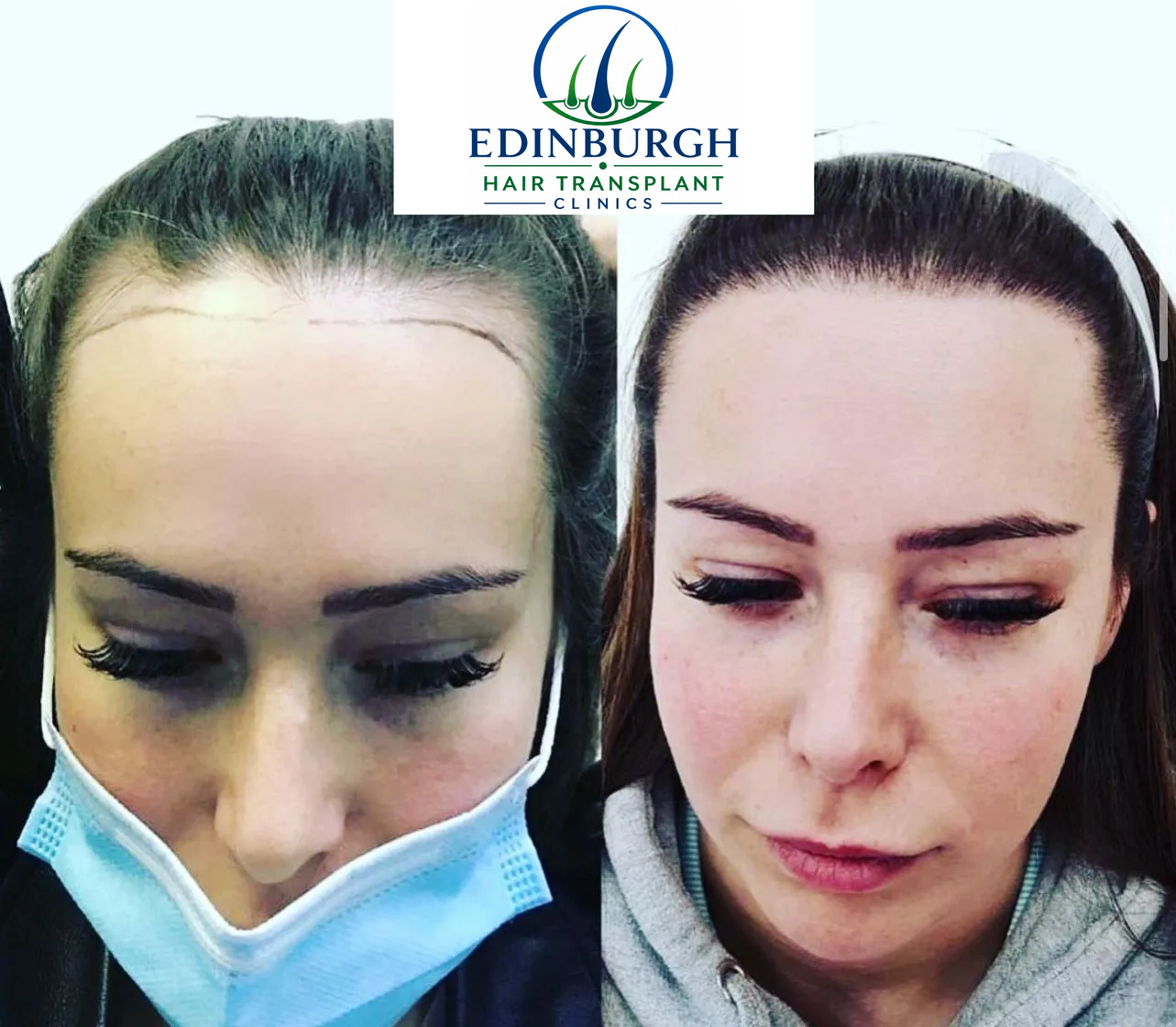 Samantha hair transplant before and after comparison