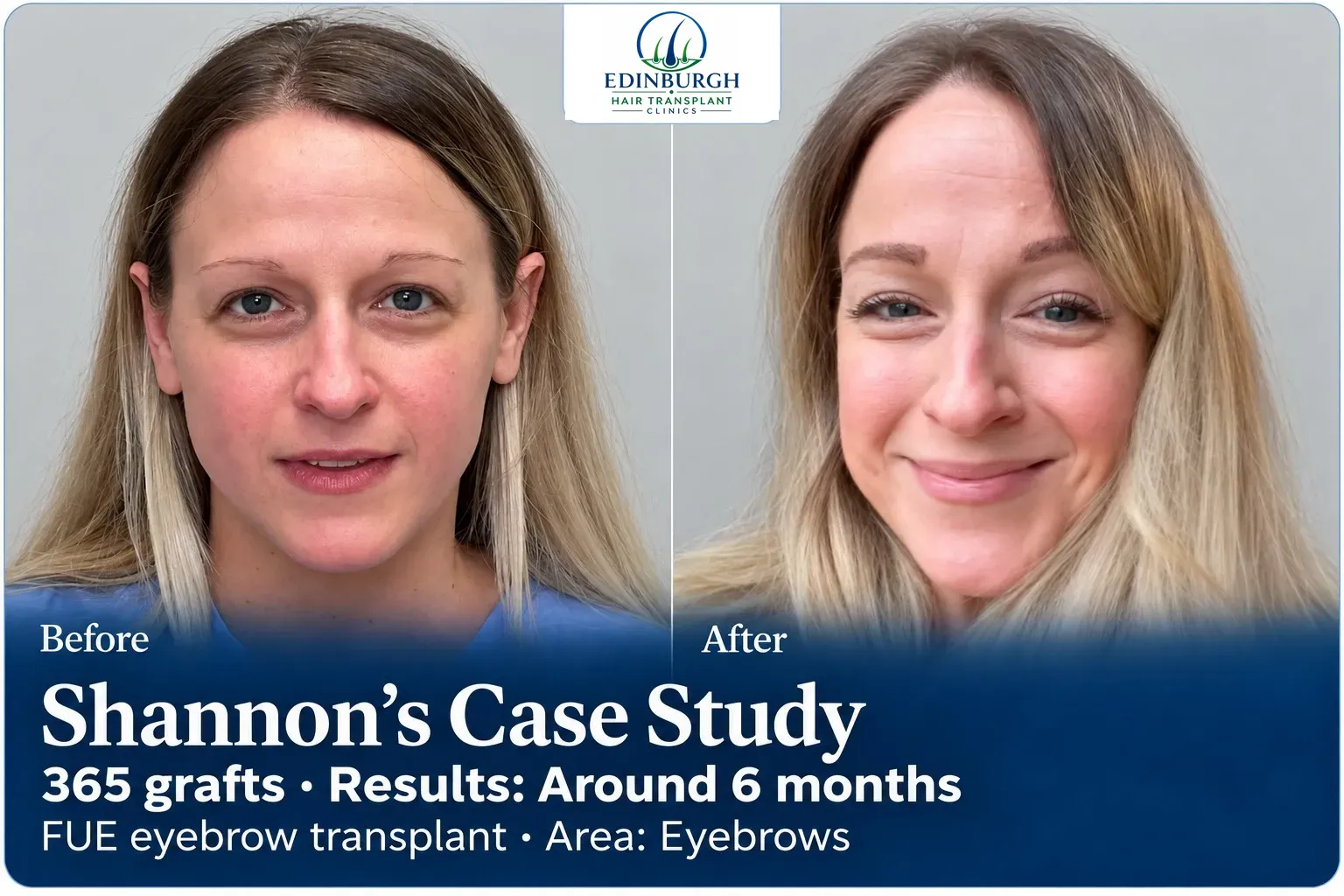 Shannon: FUE eyebrow transplant, Eyebrows, 365 grafts, results at 6 months