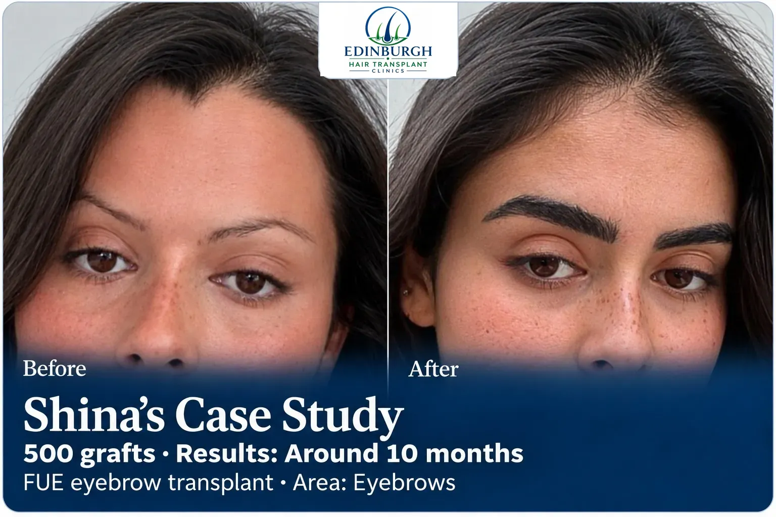 Shina: FUE eyebrow transplant, Eyebrows, 500 grafts, results at 10 months