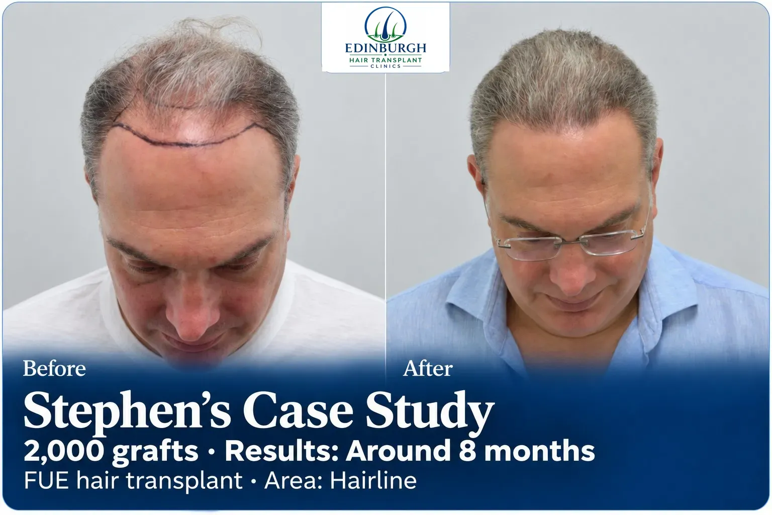 Stephen: FUE, Hairline, 2,000 grafts, results at 8 months