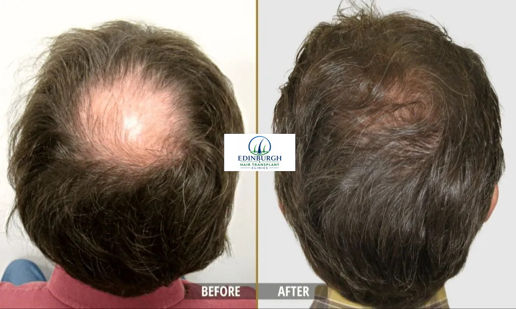 Tommy hair transplant before and after comparison