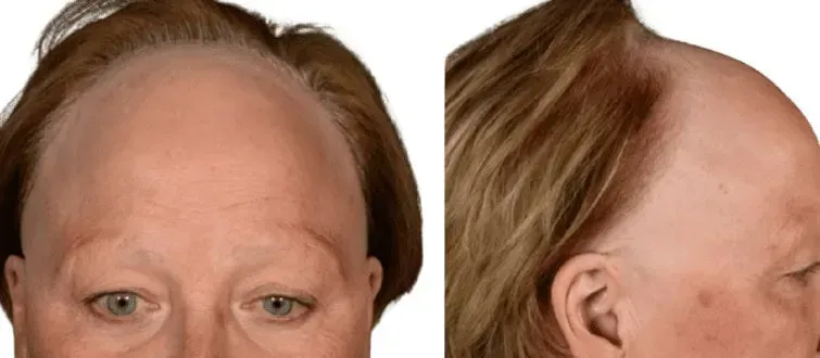 Frontal fibrosing alopecia: signs, assessment and treatment