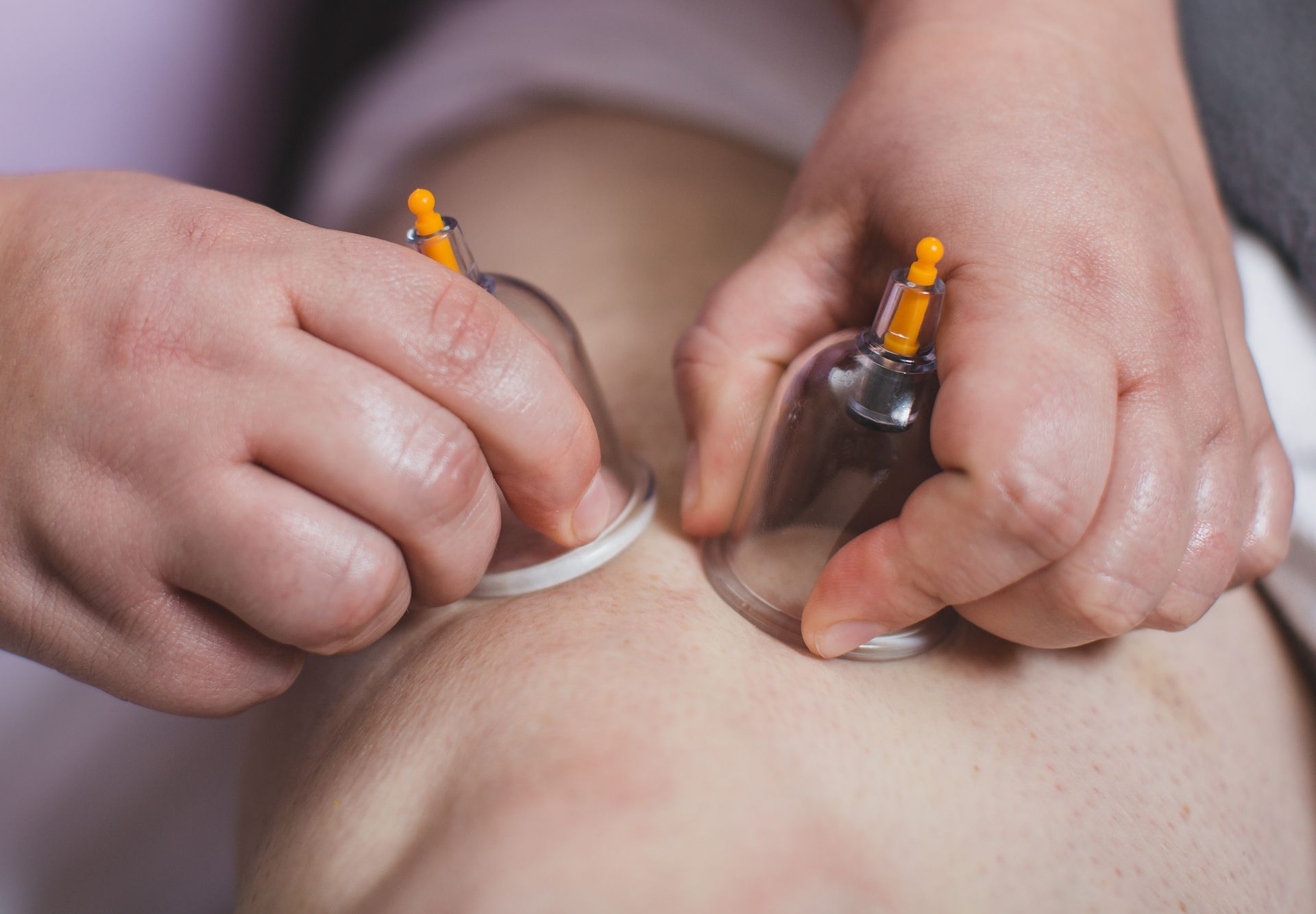 a close up of a person getting a cupping massage treatment A Touch of Recovery in Plymouth, MI