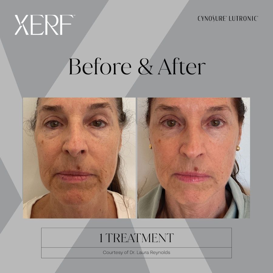 XERF skin tightening before and after