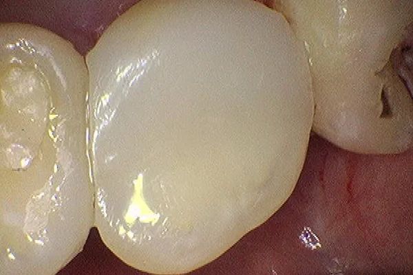 Close-up of teeth. One tooth appears to have a large, white filling.  Healthy surrounding teeth are visible.