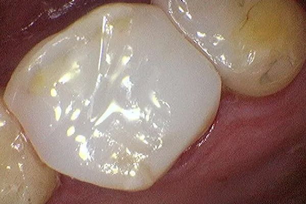 Close-up of a tooth with a shiny, light-colored filling, and adjacent teeth with slight discoloration.