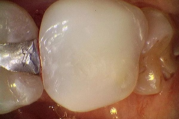 Close-up of a tooth with a white dental crown and a silver filling on an adjacent tooth.
