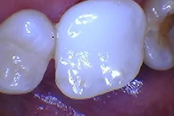 Close-up of two teeth, one with a white dental crown, in a pink-toned mouth.