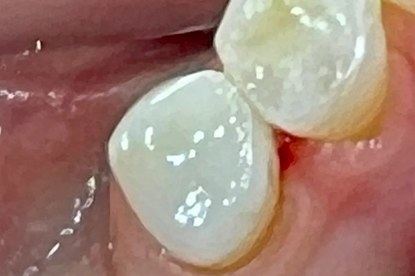 Close-up of two teeth, glossy white with hints of yellow, in pink gum tissue.
