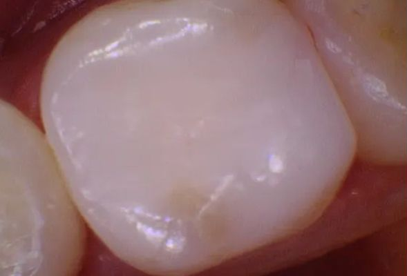Close-up of a tooth with a smooth, glossy, white surface.
