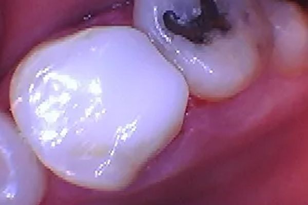Close-up of a tooth with a white filling, adjacent to a tooth with a dark filling, inside a mouth.