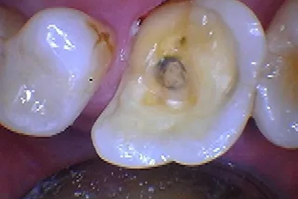 Open tooth with large cavity, yellowish interior visible, surrounded by tooth enamel.