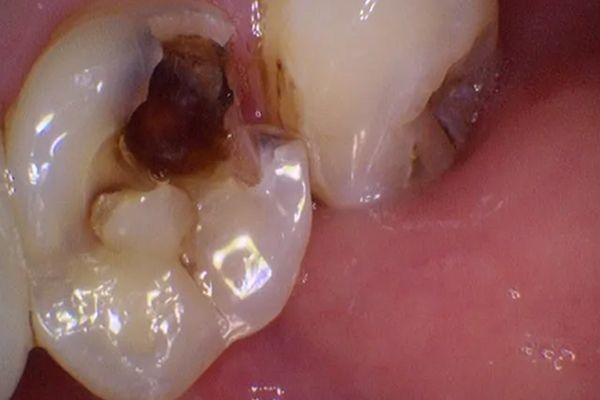 Close-up of teeth with a large cavity on one molar. The cavity is dark brown.