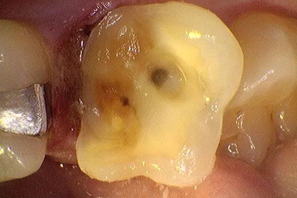Close-up of a damaged molar tooth with a cavity and discolored areas; another tooth with a silver filling is visible nearby.