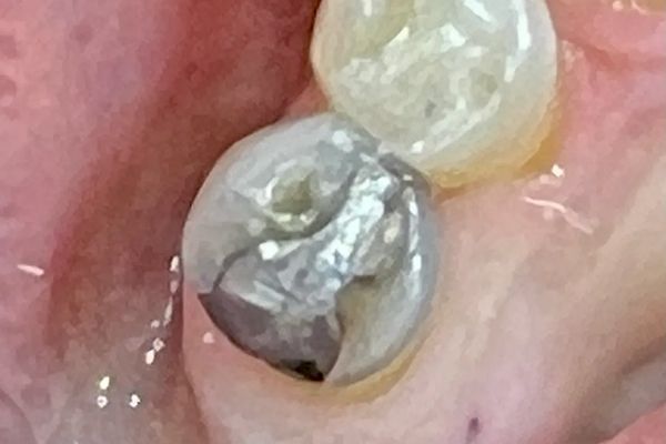 Close-up of a damaged, grey dental filling in a mouth.
