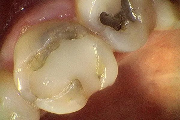 Close-up of human teeth, showing a molar with a visible cavity and a filled tooth with dark filling.