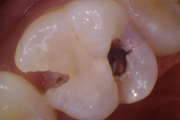 Close-up of a damaged molar tooth with a large cavity and visible decay.