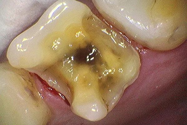 Decayed molar tooth with a deep cavity, yellow and brown discoloration, bleeding gum.