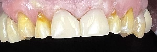 Close-up of teeth, some stained and yellow, with white central teeth, in front of pink gums.