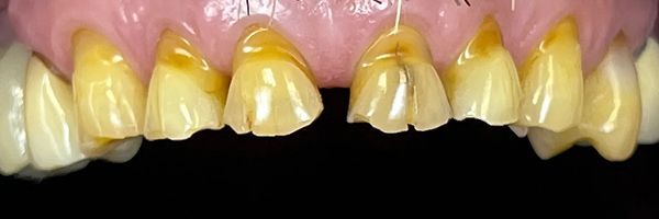 Close-up of yellowed teeth with some chips and discoloration. The gums are pink.