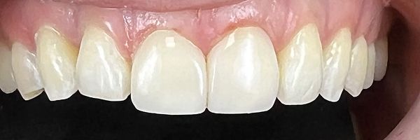 Close-up of a person's upper teeth. The teeth are white, and the gums are pink.
