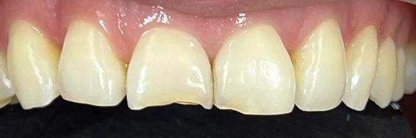 Close-up of a person's teeth. Two front teeth are chipped. The teeth are a light yellow color.