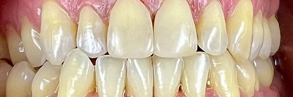 Close-up of a person's teeth, showing upper and lower rows, varying in yellow hues and some spots.