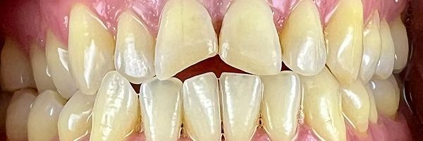 Close-up of human teeth, pale yellow color. The teeth are healthy and evenly spaced.