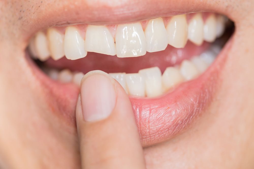 Person's mouth with a broken front tooth, finger pointing to it.