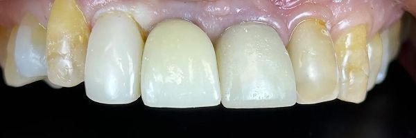 Close-up of a person's upper front teeth, some with white crowns, some with visible yellowing.