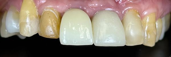 Close-up of teeth. Two central teeth appear white, while others are yellowed or discolored. Gums are visible.