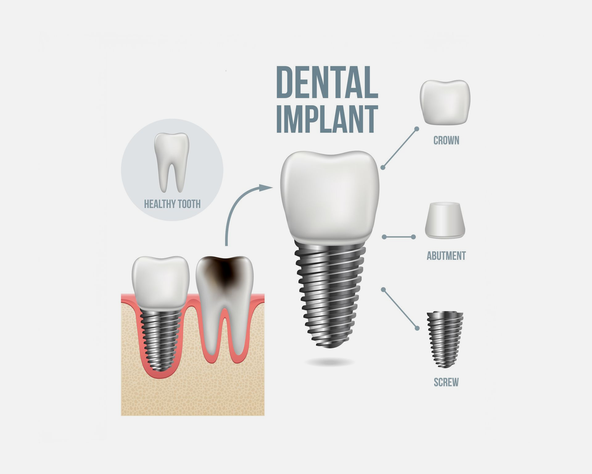 Diagram of a dental implant with labels: crown, abutment, and screw. Includes a healthy tooth and a decayed tooth.