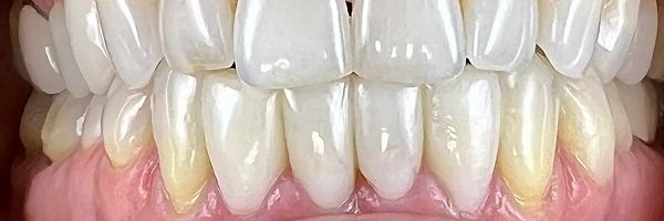 Close-up of bright, white teeth in a healthy mouth.