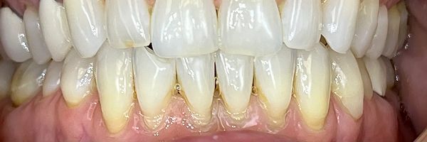 Close-up of human teeth, showing a full set of mostly straight, off-white teeth with some slight discoloration.