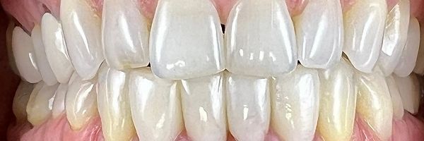 Close-up of a person's teeth. They are white and well-aligned. The gums are pink.