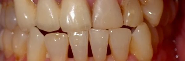 Close-up of teeth. The teeth are yellow and slightly overlapping. Red gums are visible.