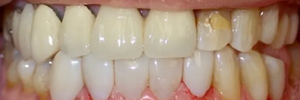 Close-up of teeth. One tooth shows a significant amount of decay with a yellow hue, suggesting poor oral health.