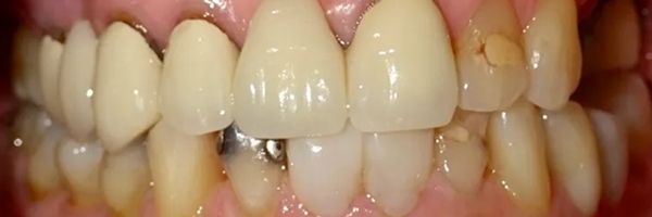 Close-up of teeth with discoloration, fillings, and a metal tooth.