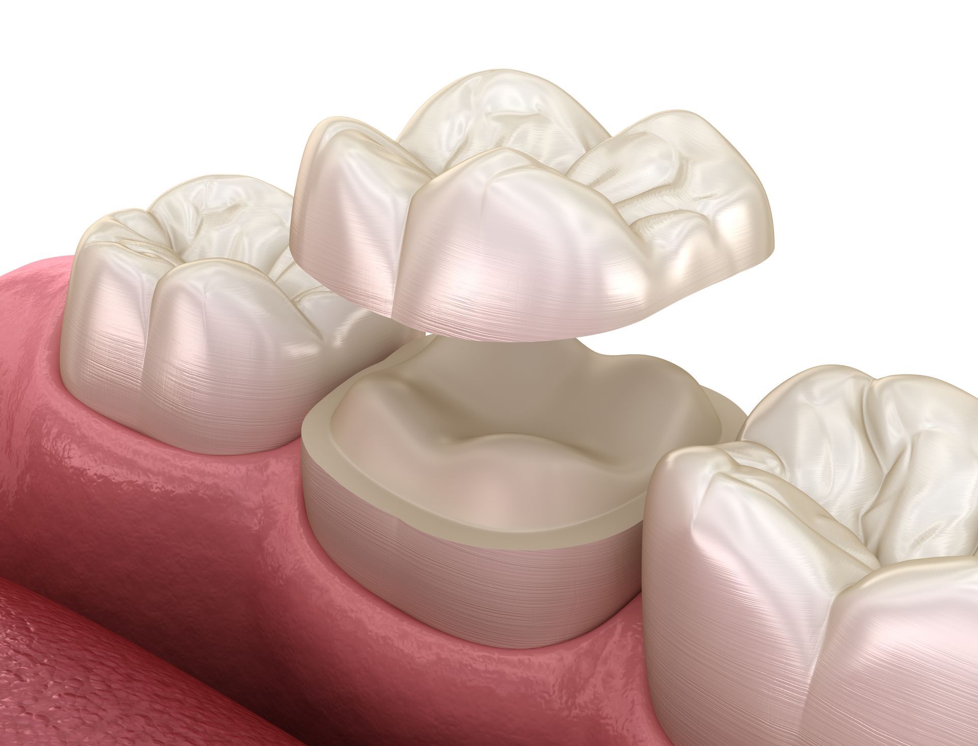 A dental crown being placed over a prepared tooth; illustration of a dental procedure.